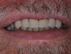 Cosmetic Crowns Case, After