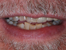 Cosmetic Crowns Case, Before