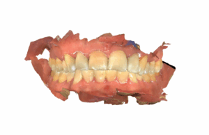 Scan Of Teeth for Evaluation of Treatment Eligibility