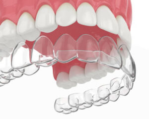 Clear Aligner